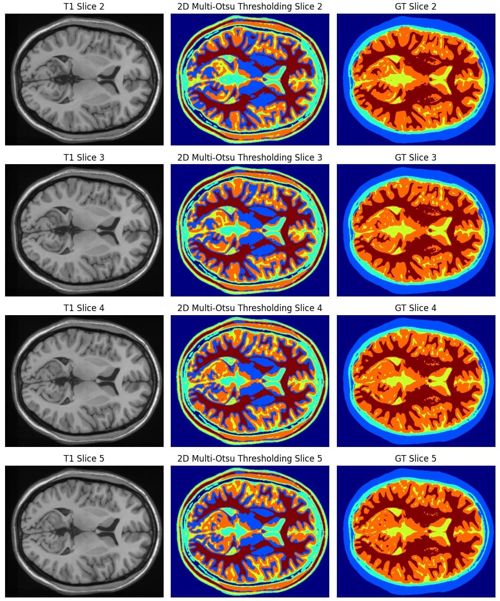 Brain MRI Tissue Segmentation