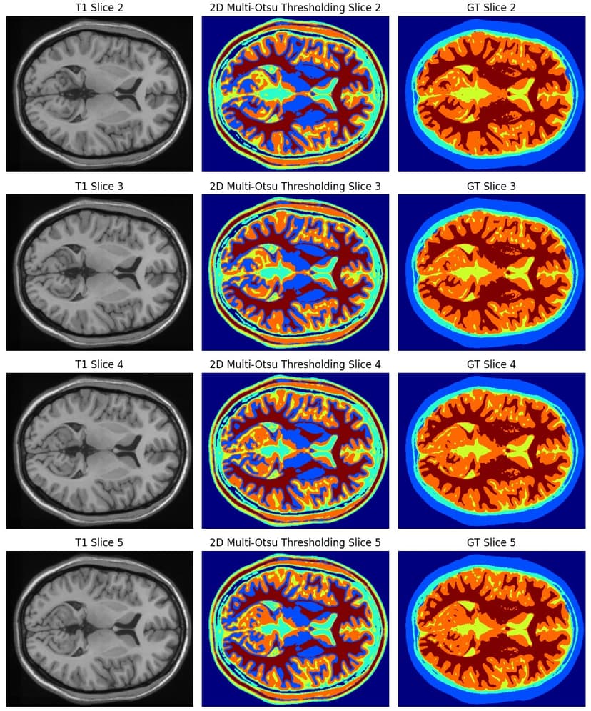 Brain MRI Tissue Segmentation